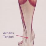 Achilles Tendinit