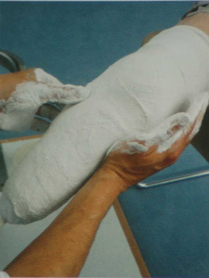 Gipsafstøbning til 
underbensprotese