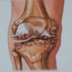 Knee osteoarthrose
